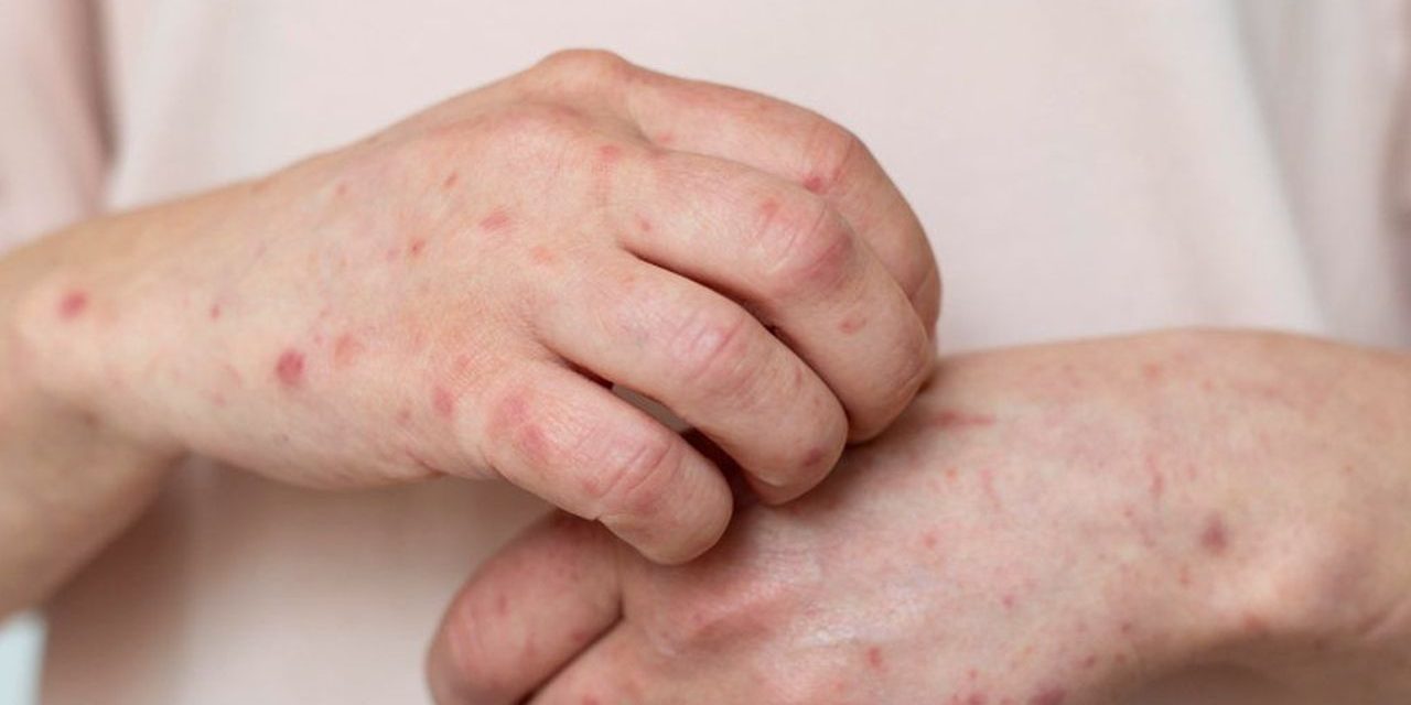 Indonesia Waspada Kasus Campak, Nakes Perketat Protokol