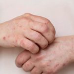 Indonesia Waspada Kasus Campak, Nakes Perketat Protokol