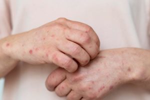 Indonesia Waspada Kasus Campak, Nakes Perketat Protokol