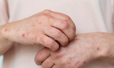 Indonesia Waspada Kasus Campak, Nakes Perketat Protokol