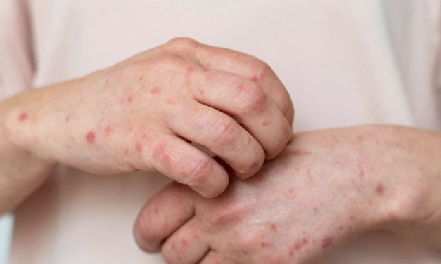 Indonesia Waspada Kasus Campak, Nakes Perketat Protokol